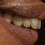 is-professional-teeth-whitening-really-worth-it-Exotic-Smile-By-Linda