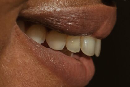 is-professional-teeth-whitening-really-worth-it-Exotic-Smile-By-Linda